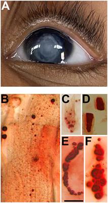 Pediatric cataracts of different etiologies contain insoluble, calcified particles